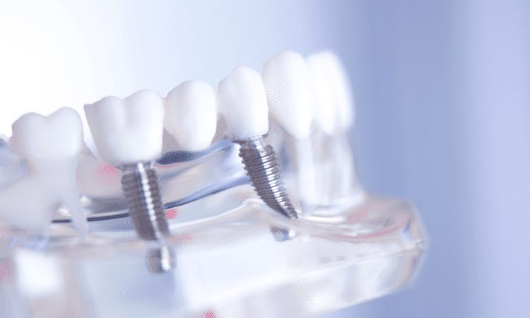 Choosing the right dental bridge depends on several factors, such as the location of the missing teeth, your budget, and overall oral health.